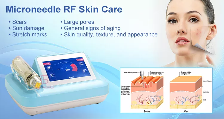 microneedling fractional rf microneedle machine